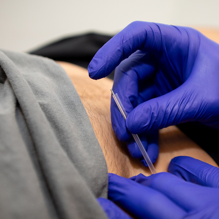 Dry needling in Atlanta